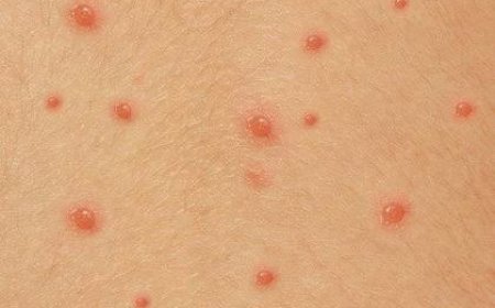 ചിക്കൻപോക്സ് പടരുന്നു: ആരോഗ്യവകുപ്പ് ജാഗ്രതാ നിർദേശം