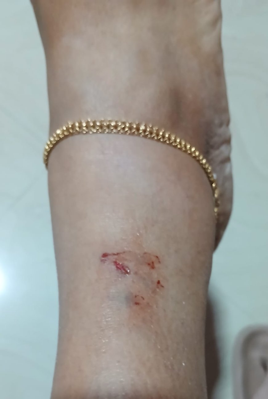 ​ കട്ടപ്പനയിൽ സെൻസസ് ഡ്യൂട്ടിക്കിടെ അധ്യാപികയ്ക്ക് വളർത്തുനായുടെ കടിയേറ്റു; സുരക്ഷ വേണമെന്ന് അധ്യാപക സംഘടനകൾ.